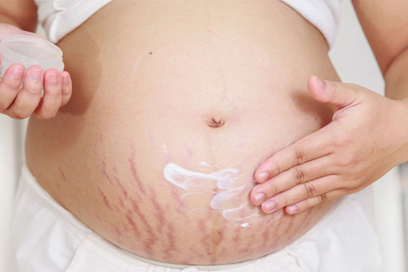 دلایل ایجاد ترک‌های پوستی بارداری چیست؟